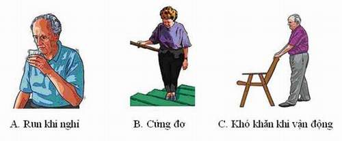 Hội chứng Parkinson - Hình ảnh minh họa